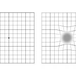 Amsler-Test, wie er aussehen sollte (links) und wie er für AMD-Patienten aussieht (rechts). // Quelle: Veronika Scheuer